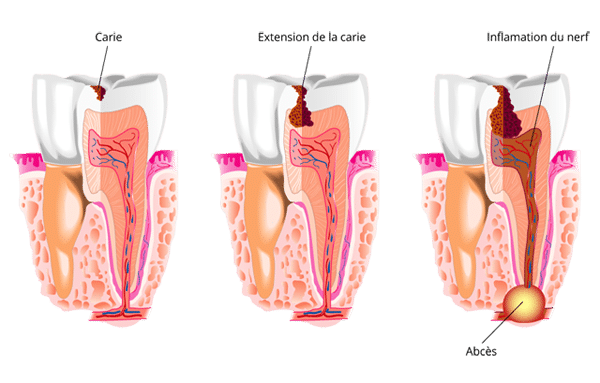 lactobacillus acidophilus cavities