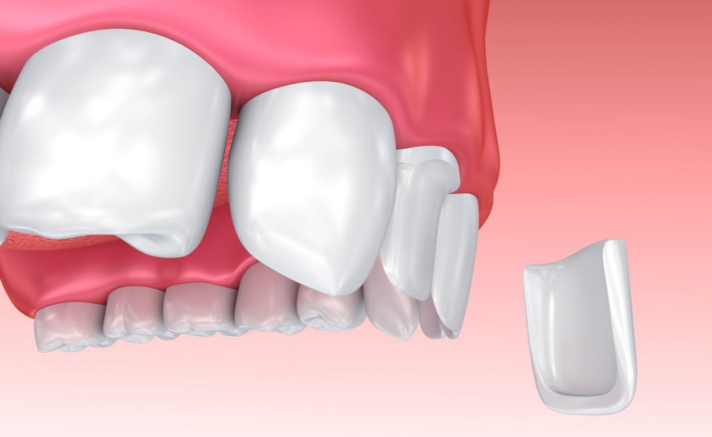 soins dentaires: Ciment dentaire provisoire  Dentaire, Santé bucco-dentaire,  Ciment dentaire