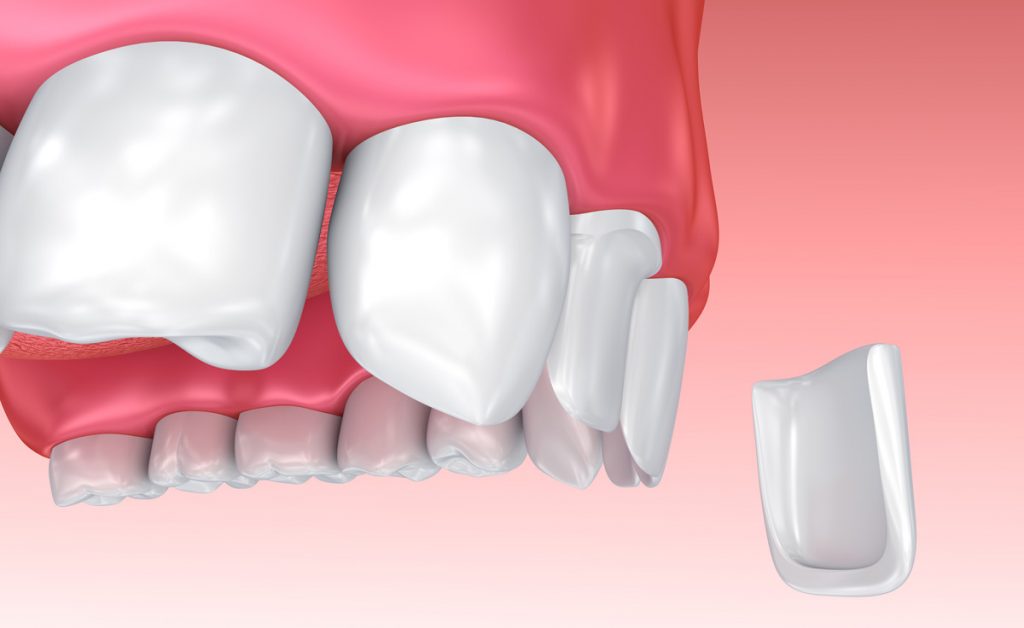 dentaire couronne, orthodontique dentier silhouette et ligne icône  ensemble. dent couronne, implant. les dents médical protection. dentaire  traitement signe. oral se soucier noir symbole collection. isolé vecteur  illustration. 34320336 Art vectoriel chez